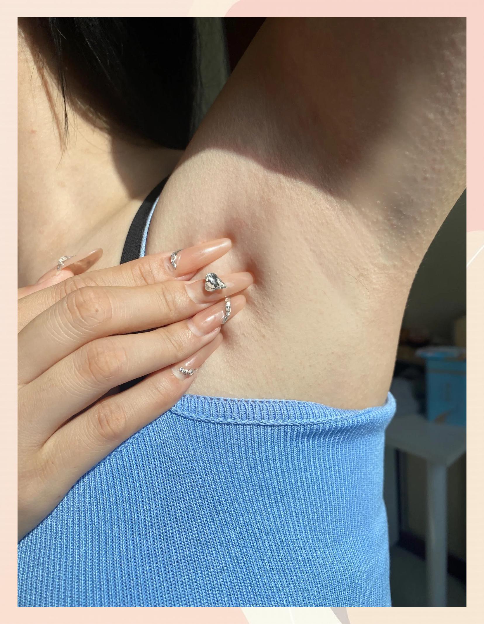 腋下黑怎么去除