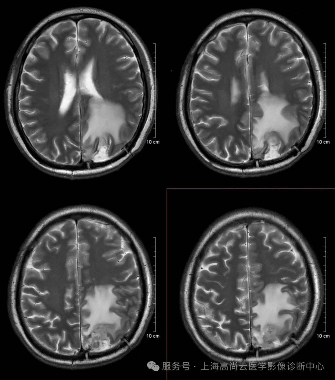 医学上MRS是什么意思